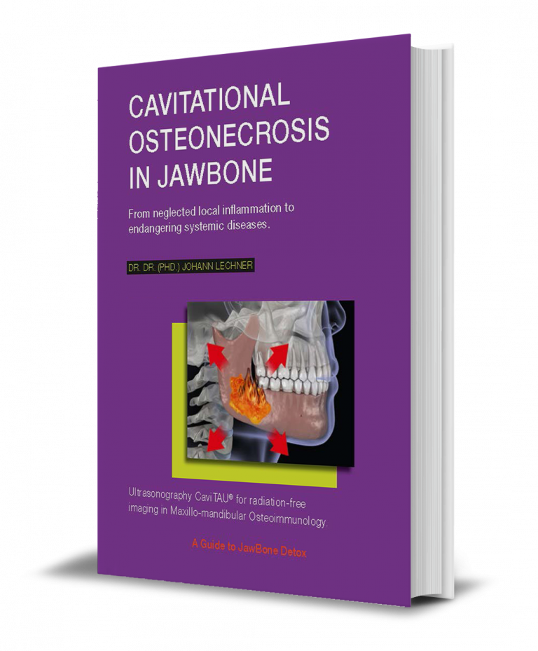 CavitationalCavitational Osteonecrosis Jawbone NEW_Osteonecrosis_Jawbone_NEW