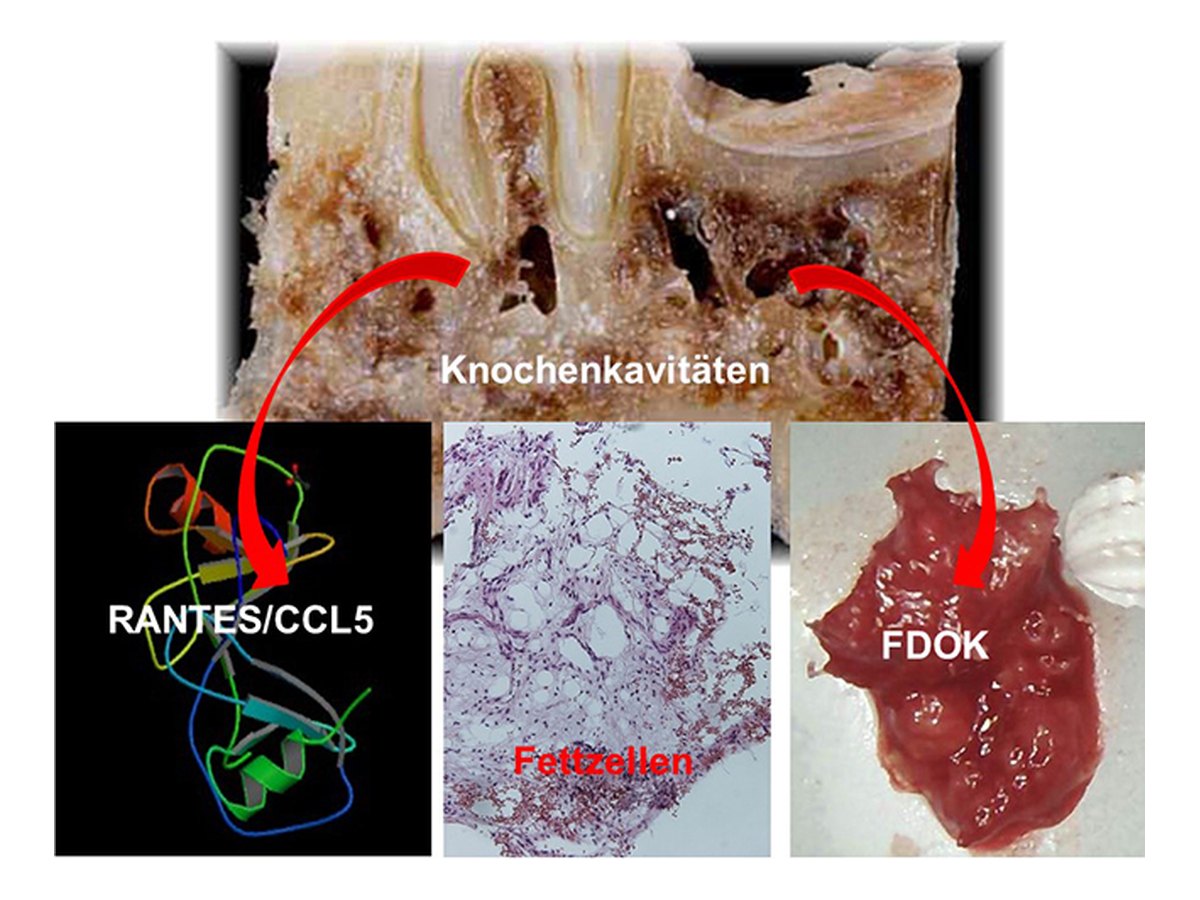 Schema der Osteoimmunologie: RANTES/CCL5 aus Knochenkavitäten des Kiefers